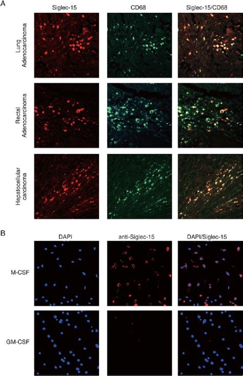 Figure 1 From The Interaction Between Siglec 15 And Tumor Associated