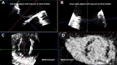 Estenose Mitral Degenerativa Casos Cl Nicos Blog Ecope