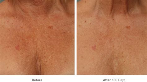 Ultherapy Chest Vancouver Laser Skin Care Clinic