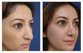 Open Rhinoplasty Cost Cosmetic Plastic Surgery Institute