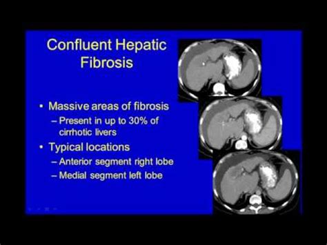 Ultrasound of Diffuse Liver Disease - YouTube