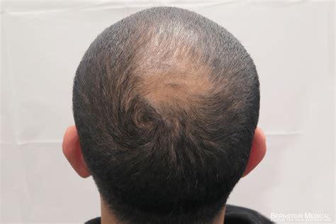 Patient Cwf Bernstein Medical Center For Hair Restoration