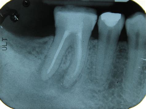 Root Canal Treated Teeth With Asymptomatic Apical Radiolucency To