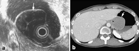 Imaging Of Gastric Leiomyoma A An Eus Image Of A Gastric Leiomyoma