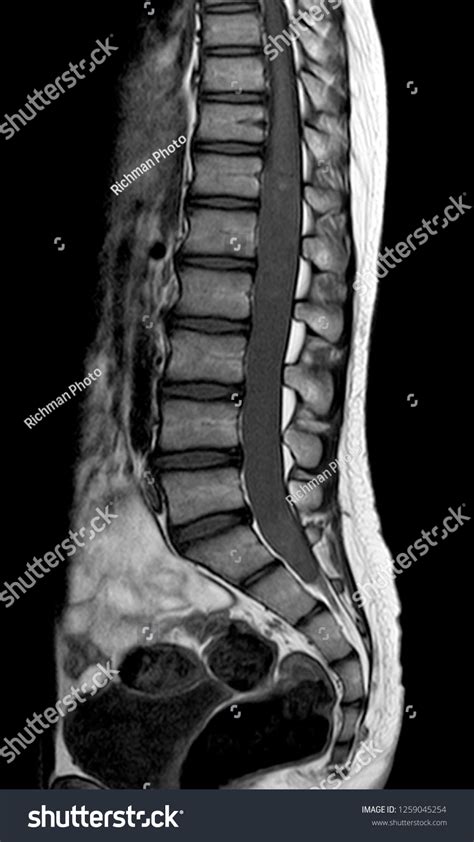 624 Imágenes De Lumbar Mri Scan Imágenes Fotos Y Vectores De Stock