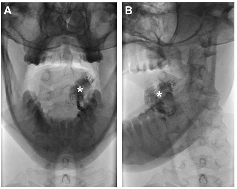 Jcm Free Full Text Ct Lymphography Using Lipiodol® For Sentinel