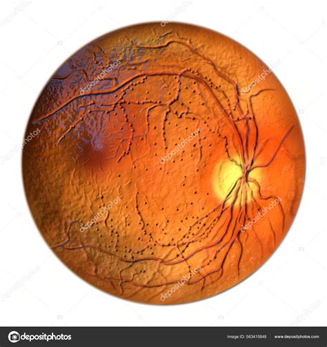 Non Proliferative Diabetic Retinopathy Ophthalmoscope View Fluorescein Angiography Illustration