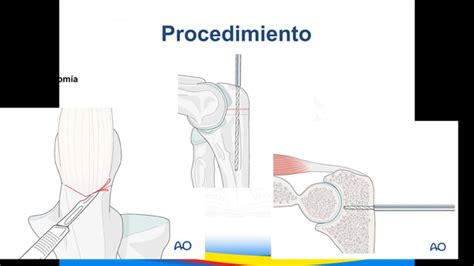 Osteosíntesis de fractura de humero distal pptx