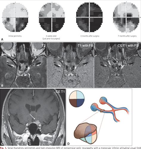 Figure 1 from Acute-Onset Altitudinal Visual Field Defect Caused by ...