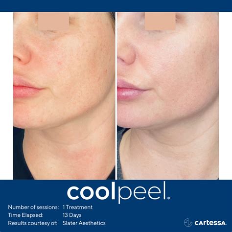 Cool Peel / CO2 Laser | Atlantic Aesthetics Maine