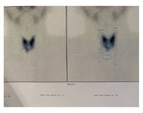 Tc 99 Thyroidal Uptake Scan Download Scientific Diagram