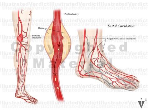 Stock Lower Limb Clots Plaques In Vasculature Illustrated Verdict