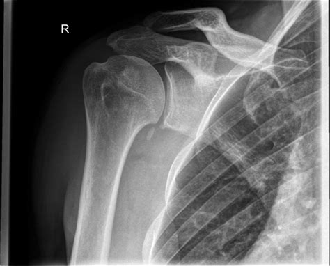 Preoperative X Rays In Anteroposterior Projection Download Scientific Diagram