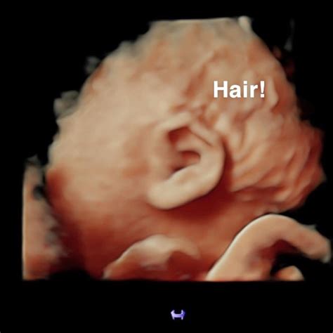 Hair On Ultrasound