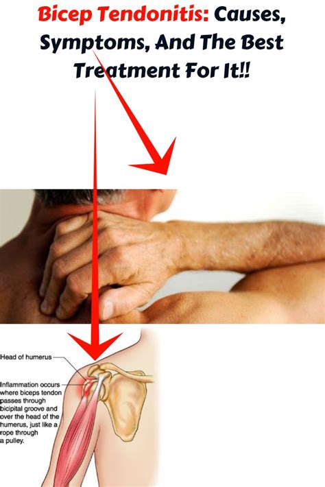 Bicep Tendonitis Causes Symptoms And The Best Treatment For It