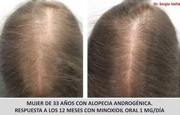 Dutasteride and Minoxidil Before and After Photos | Hair Loss Cure 2020