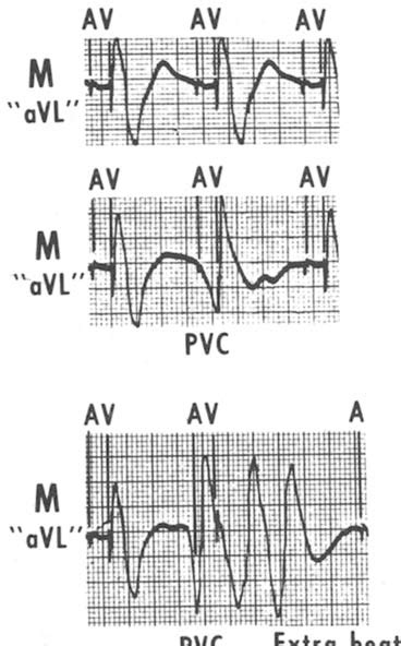 Figure 2 From Ventricular Tachycardia Produced By A Normally Functioning Av Sequential Demand