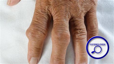 Treat-to-target With Urate Lowering Therapy Recommended for All Gout Patients | Rheumatology Network