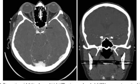 Figure 2 From Endoscopic Endonasal Clipping Of An Unsecured Superior