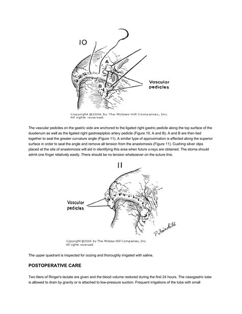 Hemigastrectomy Billroth I Method Pdf