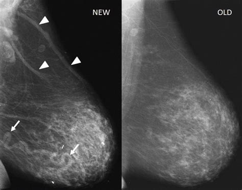 Vascular Abnormalities Of The Breast Arterial And Venous Disorders