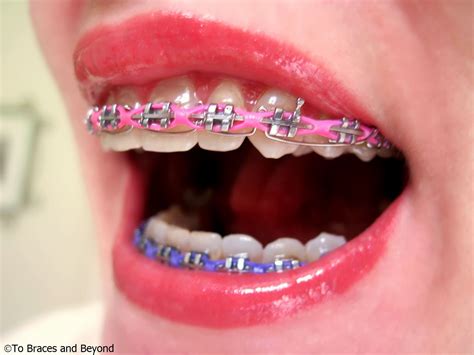 Pin By Love Peach On Silver Smile Close Up Cute Braces Teeth Braces