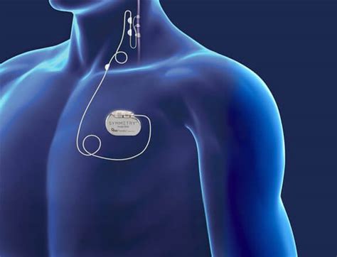 Reviving Hope And Healing Exploring Vagus Nerve Stimulation Vns