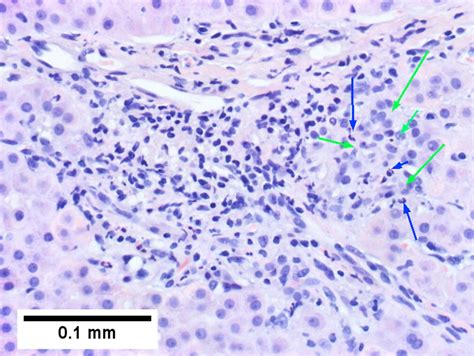 Primary Sclerosing Cholangitis Libre Pathology