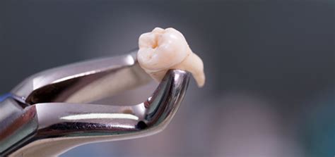 Estrazione Denti Del Giudizio Studio Dentistico Sante Vassallo