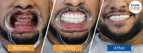 Dental Implants Before and After Pictures of Hundreds of Satisfied Patients