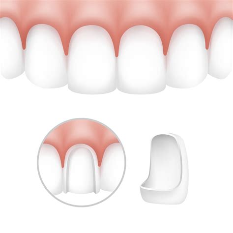Porcelain Laminate Veneers What When And How 10