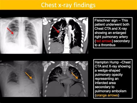 Med4yu Pulmonary Embolism