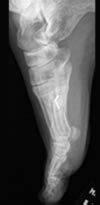 Nonunion Foot Case Dr Mark Brinker Houston Orthopedic Surgeon