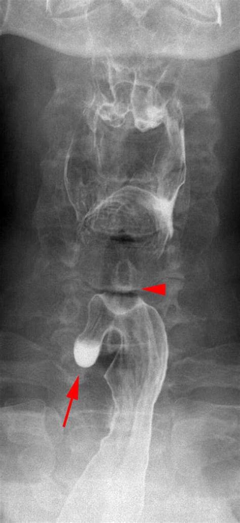 Killian–Jamieson diverticulum - Wikiwand