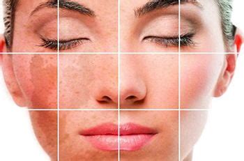 Skin Discoloration Treatment | Best Dermatologists in Brooklyn