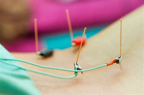 Acupuncture May Help Treat Hot Flashesunderground Health Reporter