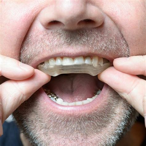 Bruxism Teeth Grinding Healthridge Trinity Dental Heathridge