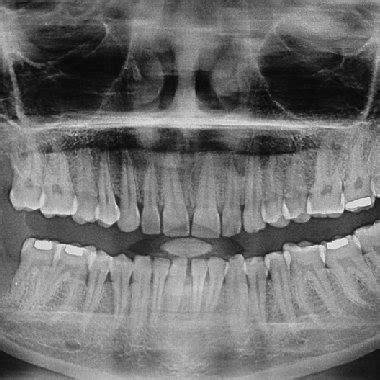 Orthopantomograph Showing Large Unilocular Radiolucent Lesion On The