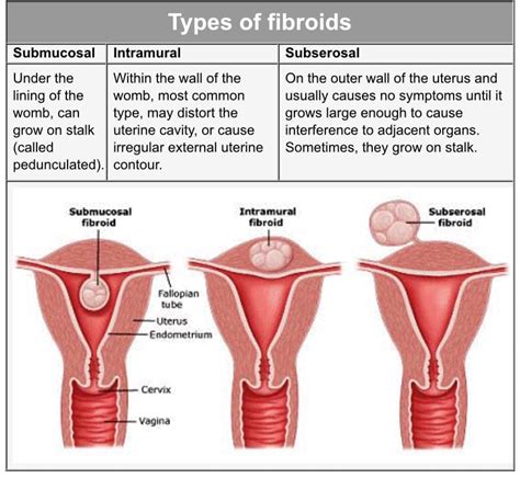 Myomectomy Surgery Uterine Fibroids Treatment In Thane Mumbai India