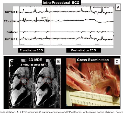 Figure From Electroanatomic Mapping And Radiofrequency Ablation Of