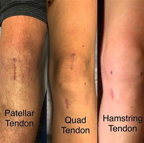 Acl Knee Injury Surgery Or Not Central Performance