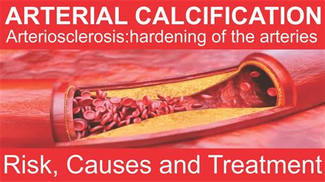 Arterial Calcification Risks Causes And Treatments Youtube