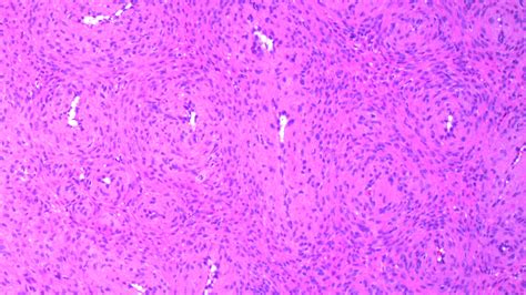 Angioleiomyoma Mypathologyreport Ca