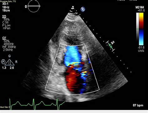 Transthoracic Echocardiogram With Two Chamber Apical View Showing