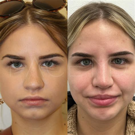 Rhinoplastie Ultrasonique Montr Al Clinique Face Md Rhinoplastie