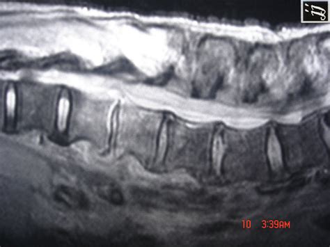 L L Tb Discitis Radiopaedia