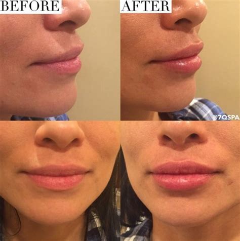 Half A Syringe Lip Filler Before And After Before And After