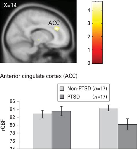 A Regional Cerebral Blood Flow Rcbf Decreases During The