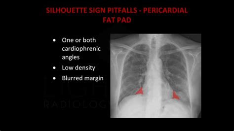 Lung Ultrasound Made Easy Step By Step Guide Pocus Off