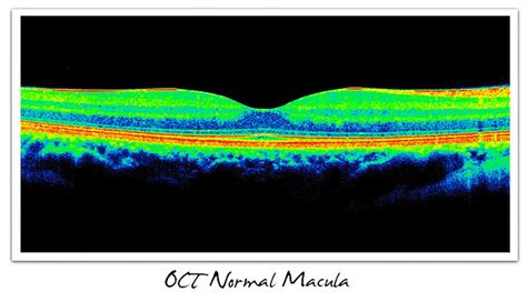 Normal Maculahigh Res Cure Amd Foundation